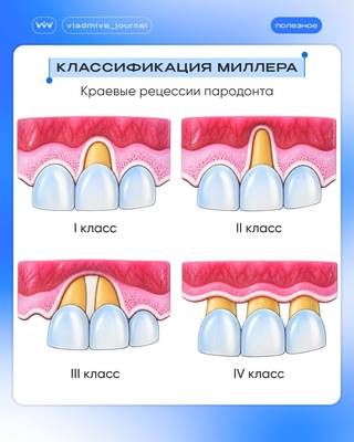 Классификация Миллера: прогноз закрытия рецессий десны.